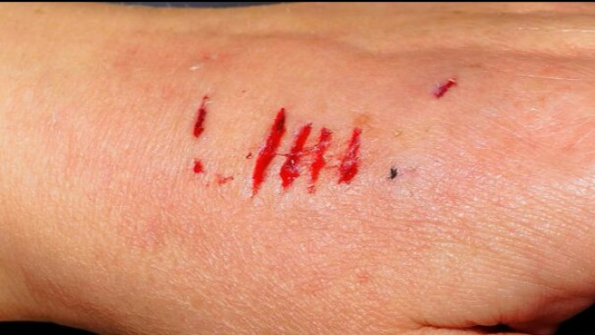 Cara Mengobati Gigitan Hewan yang Benar Agar Tidak Infeksi