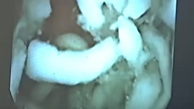 Sering Makan Mie Instan? Seperti Ini 'Perjalanannya' di Perut