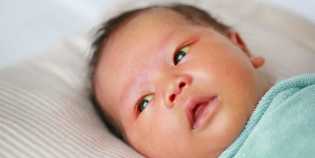 Waspadai Ciri-ciri Gejala Penyakit Kuning Pada Anak yang Perlu Dikenali