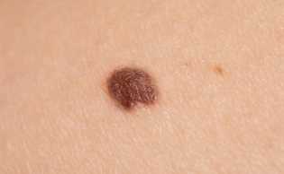 Miliki Tahi Lalat di Kaki, YouTuber Ini Didiagnosis Kanker