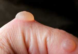 Ingat! Bukan Pakai Pasta Gigi atau Kecap, Ini Pertolongan Pertama saat Kulit Melepuh