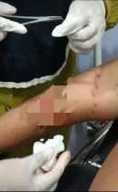 Lengan Robek Bekas Gigitan, Warga Sikakak Kuansing Diduga Diterkam Buaya Saat Mandi Malam di Batang Kuantan