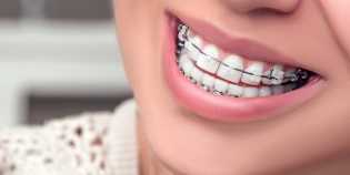 Makanan yang Boleh dan Tak Boleh Dimakan Setelah Pasang Behel