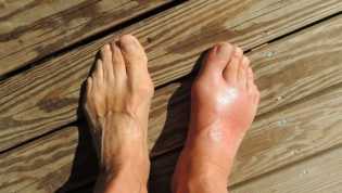 Ini 8 Cara Menghilangkan Asam Urat di Kaki yang Ampuh
