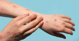 Cacar Monyet Ditemukan Di Jakarta