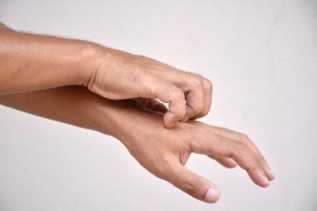 Kasus Cacar Monyet Didominasi Orang Dewasa, Begini Cara Mencegahnya